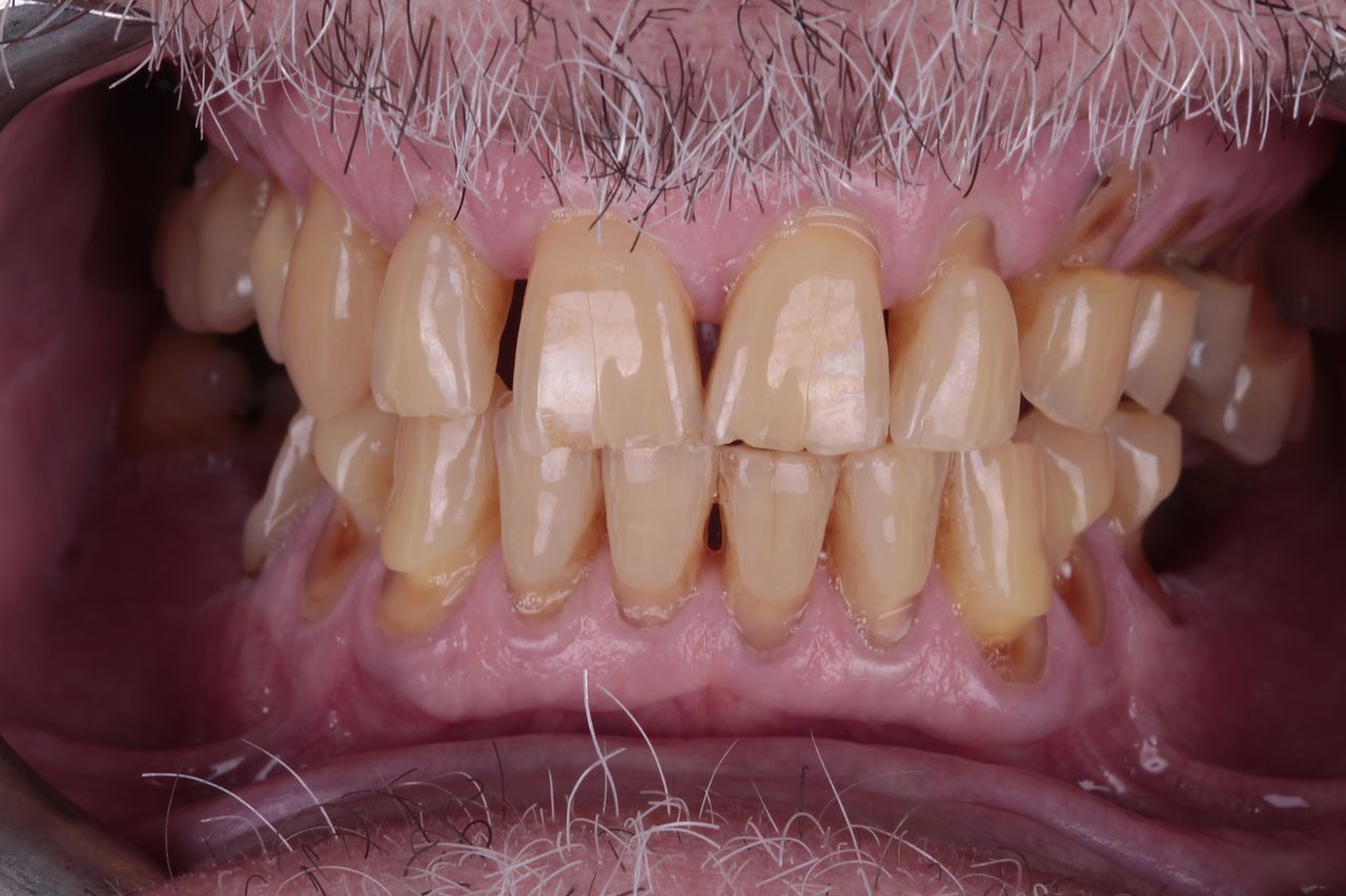 Antes: dientes desgastados y oscurecidos