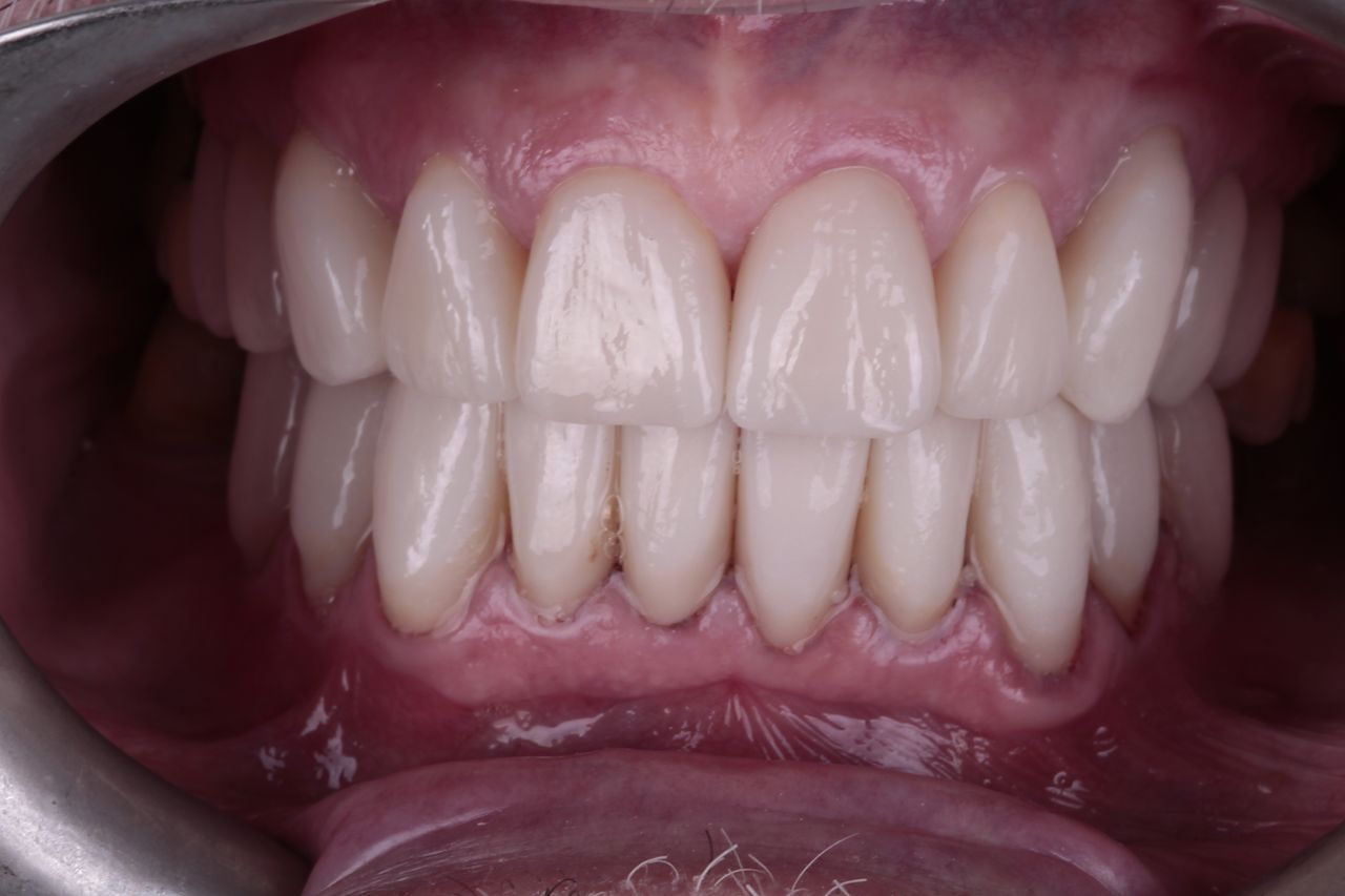 Después: sonrisa renovada con carillas de cerámica