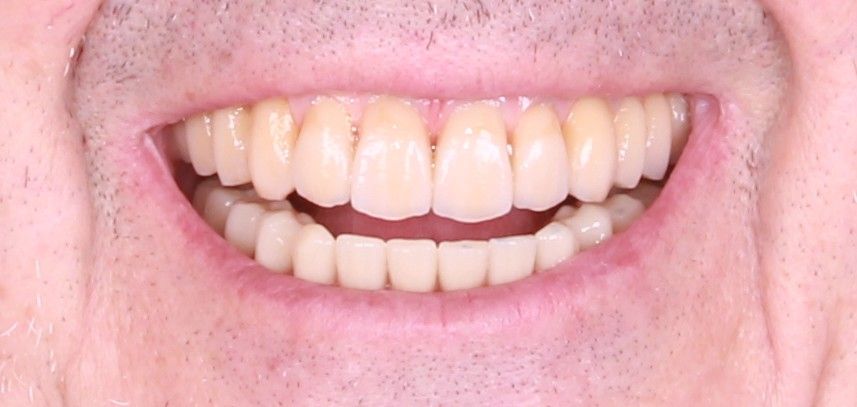 Sonrisa final tras rehabilitación full-arch sobre implantes