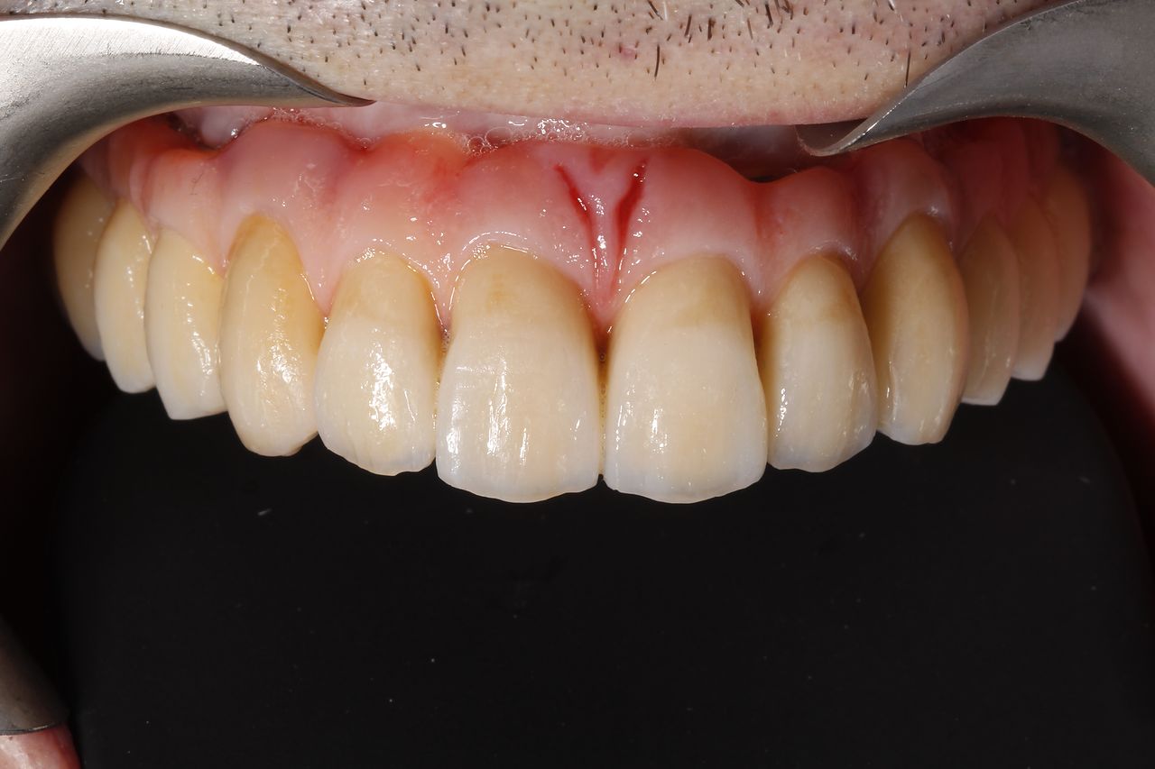 Detalle clínico de la arcada completa fija sobre implantes