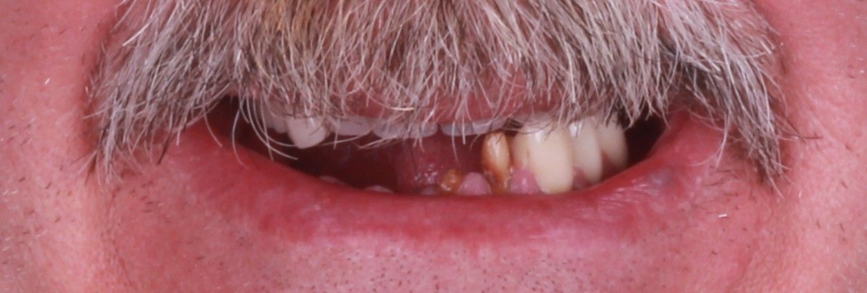 Antes del tratamiento: deterioro y pérdida de piezas dentales