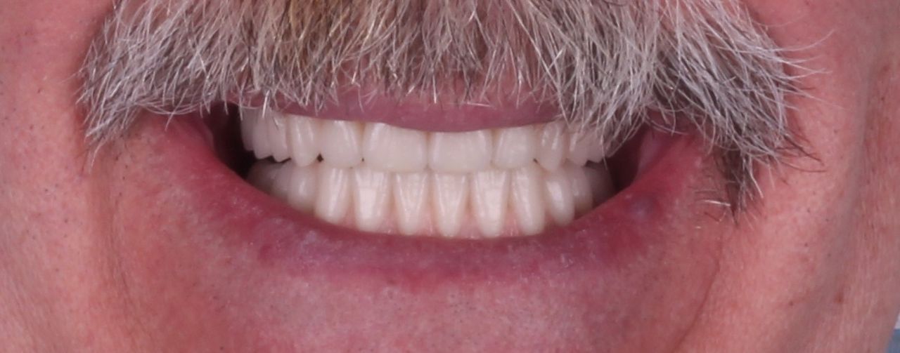 Después: sonrisa rehabilitada con prótesis removible completa