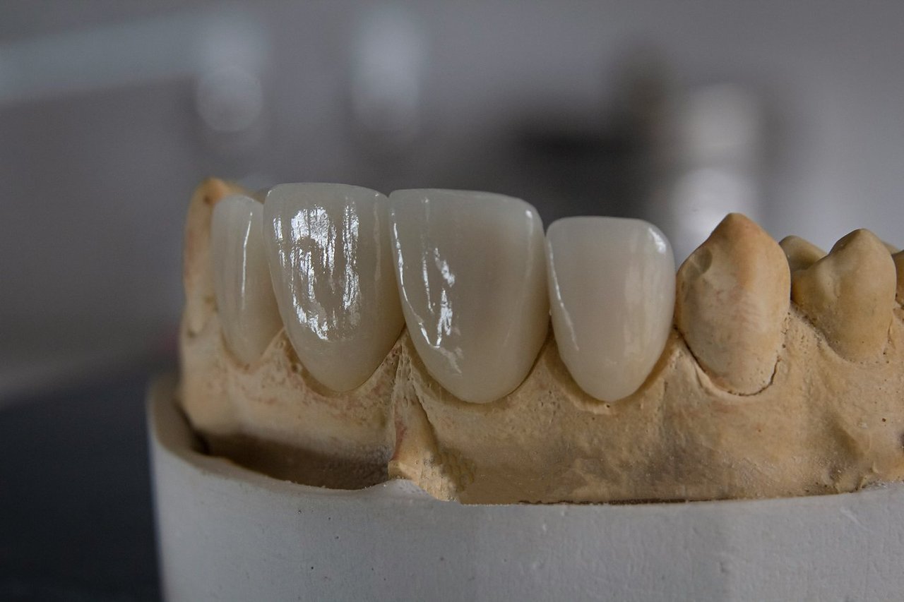 Prótesis fija cerámica para rehabilitación All-on-4 sobre modelo dental