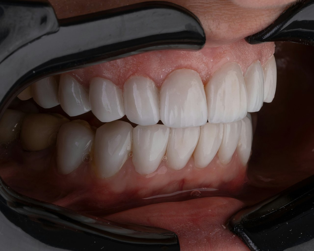 Sonrisa blanca tras blanqueamiento dental profesional con retractores